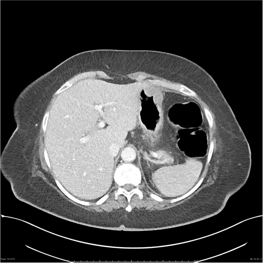 Bilateral psoas hematomas (Radiopaedia 24057-24279 A 19).jpg