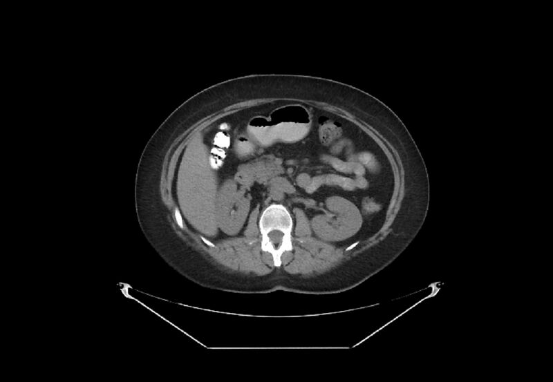 File:Bilateral urolithiasis with incidentally detected splenic artery aneurysm and left inferior vena cava (Radiopaedia 44467-48123 Axial non-contrast 20).jpg
