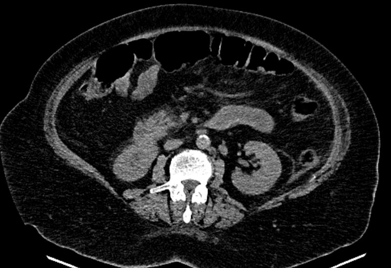 File:Biliary pancreatitis (Radiopaedia 72289-82823 Axial non-contrast 130).jpg