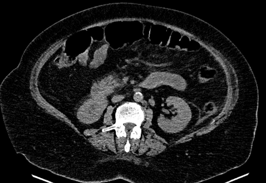 Biliary pancreatitis (Radiopaedia 72289-82823 Axial non-contrast 130).jpg