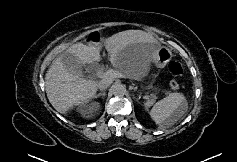 File:Biliary pancreatitis (Radiopaedia 72289-82823 Axial non-contrast 85).jpg