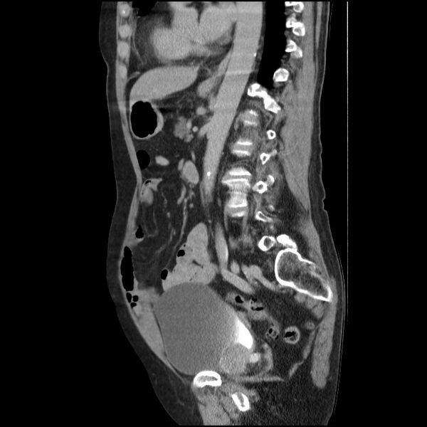 File:Bladder tumor detected on trauma CT (Radiopaedia 51809-57609 E 31).jpg
