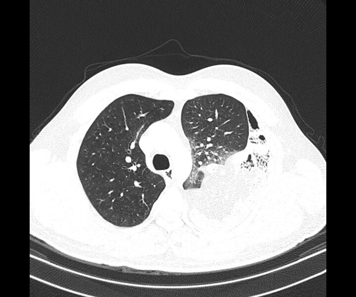 File:Bochdalek hernia - adult presentation (Radiopaedia 74897-85925 Axial lung window 14).jpg