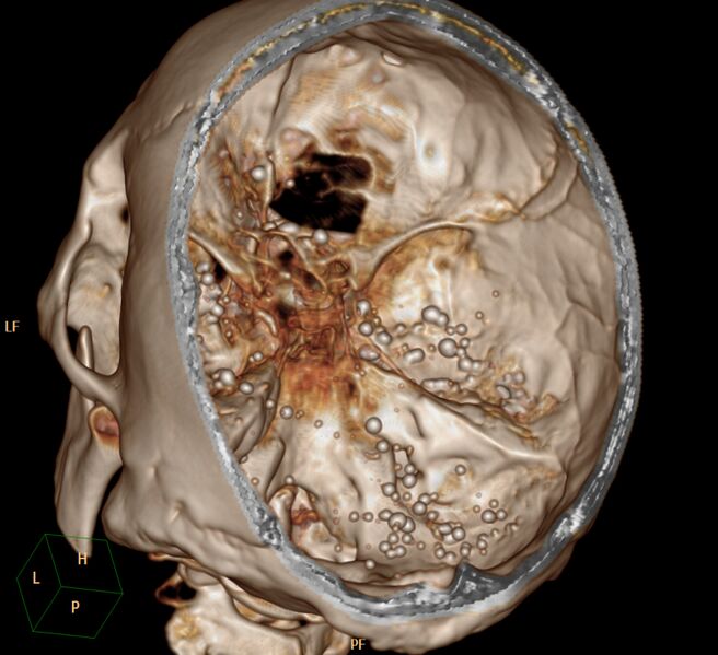 File:Brain Pantopaque remnants (Radiopaedia 78403-91048 3D VRT 1).jpg