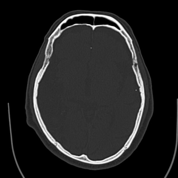 File:Brain Pantopaque remnants (Radiopaedia 78403-91048 Axial bone window 36).jpg
