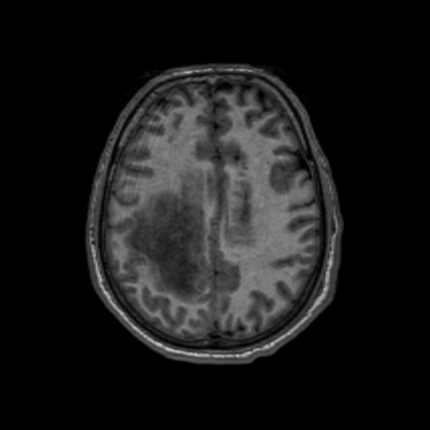 Brain abscess complicated by intraventricular rupture and ventriculitis (Radiopaedia 82434-96577 Axial T1 48).jpg