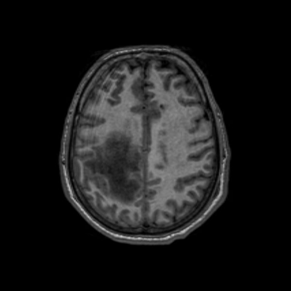 File:Brain abscess complicated by intraventricular rupture and ventriculitis (Radiopaedia 82434-96577 Axial T1 50).jpg