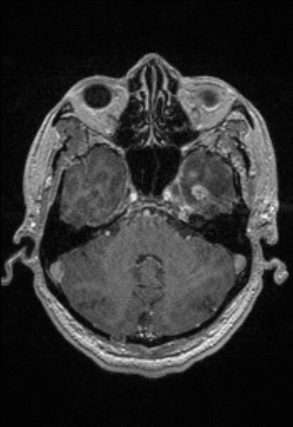 File:Brain abscess with ventriculitis (Radiopaedia 85703-101495 Axial T1 C+ 51).jpg