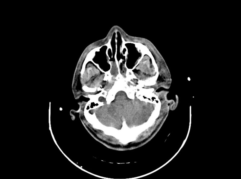 File:Brain injury by firearm projectile (Radiopaedia 82068-96087 B 55).jpg