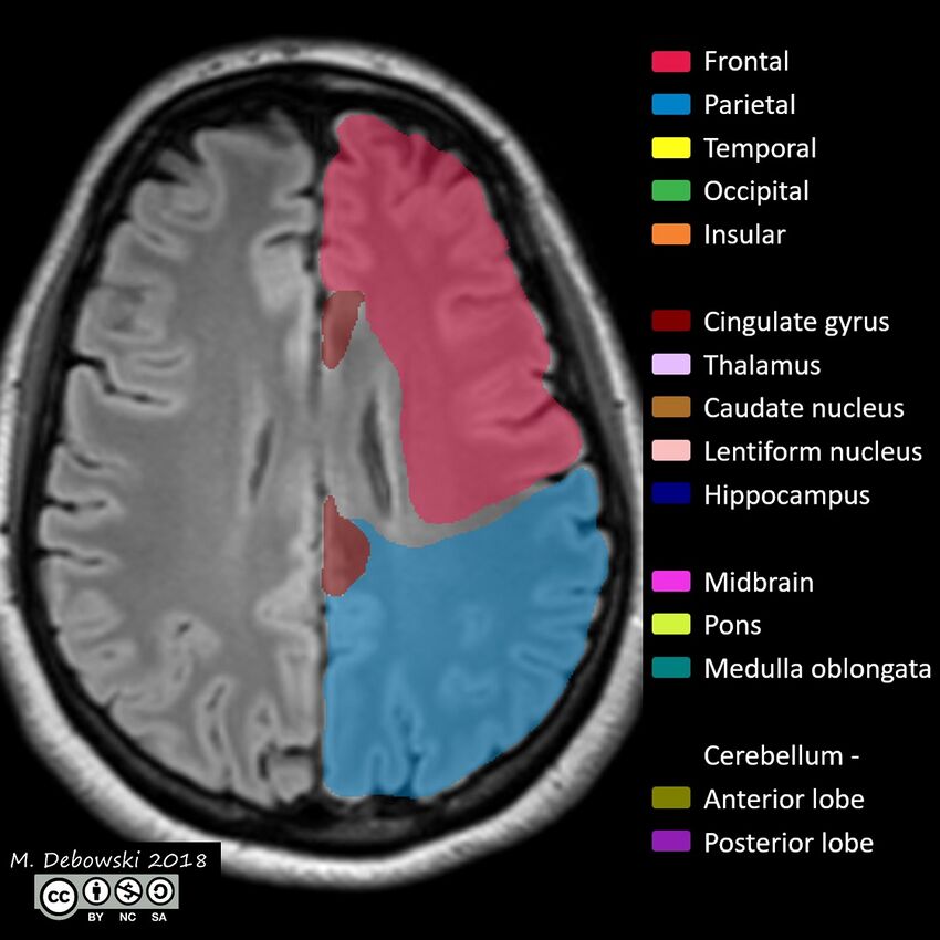 Brain lobes - annotated MRI (Radiopaedia 61691-69700 Axial 25).JPG