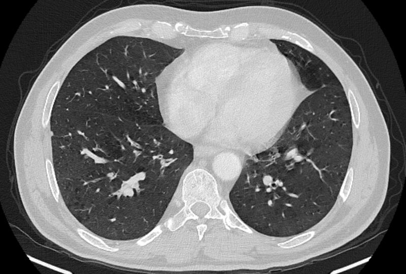 File:Brain metastases - lung cancer primary (Radiopaedia 75060-86116 Axial lung window 41).jpg