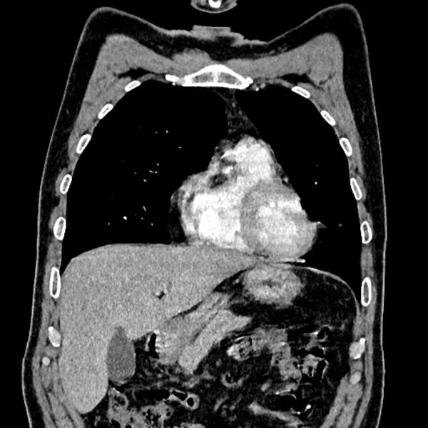 File:Brain metastases - lung cancer primary (Radiopaedia 75060-86116 C+ arterial phase 16).jpg