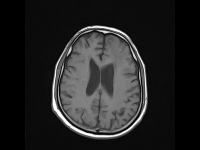 File:Brain metastases from renal cell carcinoma (Radiopaedia 42222-45297 Axial T1 17).jpg