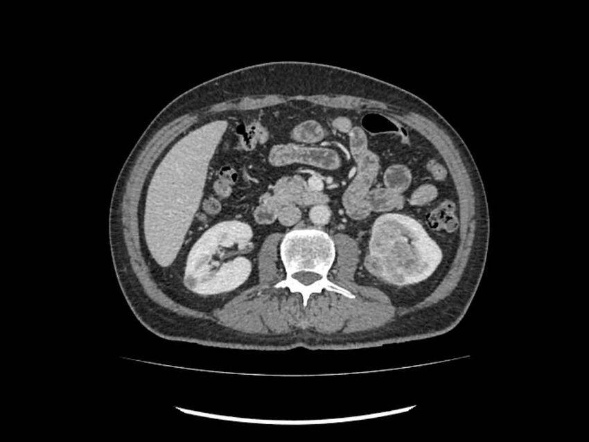 Brain metastases from renal cell carcinoma (Radiopaedia 42222-45328 B 112).jpg