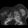 Breast cancer (CT appearances) (Radiopaedia 18545-18413 Coronal non-contrast 1).JPEG