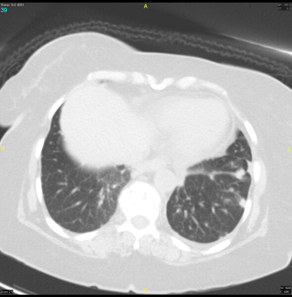 File:Breast primary with lung and bone metastases (Radiopaedia 40620-43228 Axial lung window 39).jpg