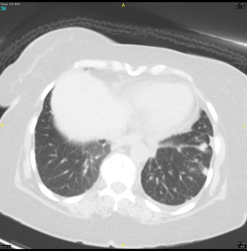 Breast primary with lung and bone metastases (Radiopaedia 40620-43228 Axial lung window 39).jpg