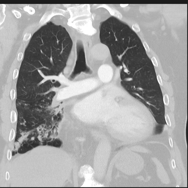 File:Bronchiectasis (Radiopaedia 39385-41666 Coronal lung window 16).png