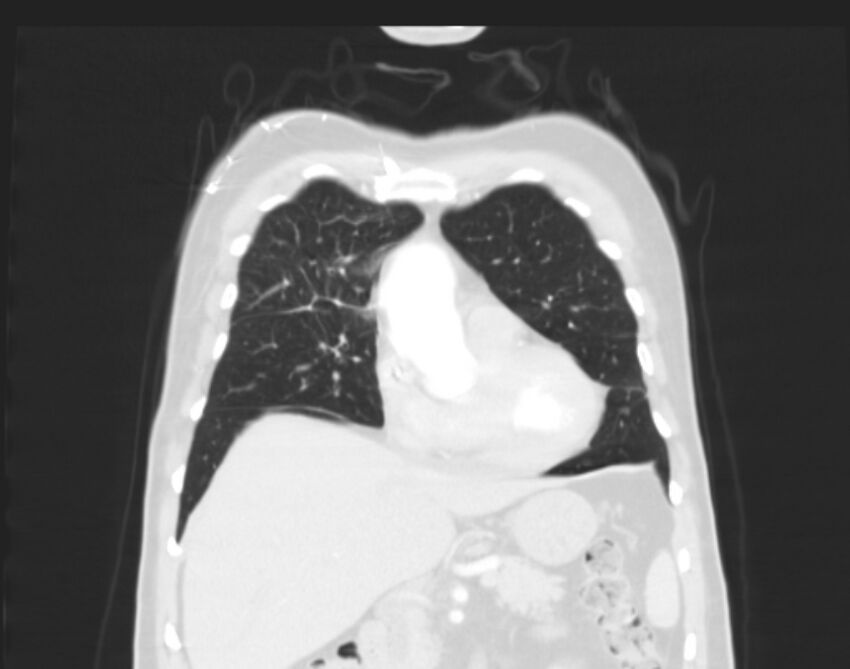 Bronchogenic carcinoma with lymphangitic spread (Radiopaedia 29002-29357 Coronal lung window 18).jpg