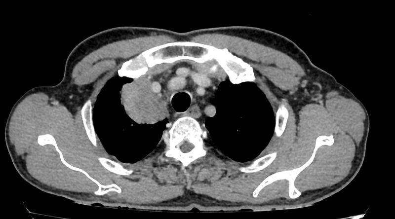 File:Bronchogenic carcinoma with superior vena cava syndrome (Radiopaedia 36497-38054 Axial C+ delayed 11).jpg
