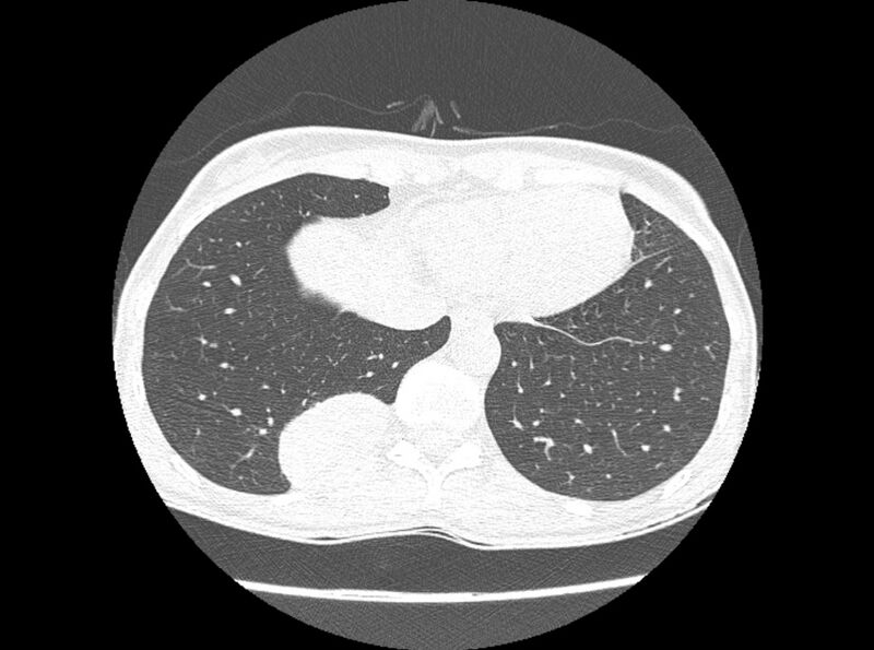 File:Bronchogenic cyst (Radiopaedia 80273-93615 Axial lung window 17).jpg