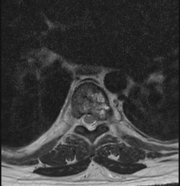 File:Brown tumors compressing the spinal cord (Radiopaedia 68442-78030 A 30).jpg