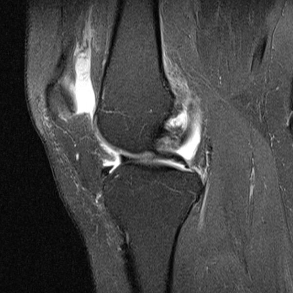File:Bucket handle tear - medial meniscus (Radiopaedia 79028-91942 Sagittal PD fat sat 15).jpg