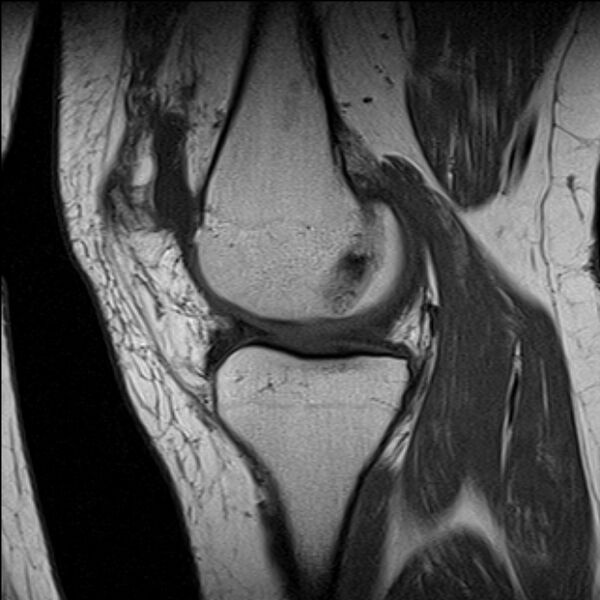 File:Bucket handle tear - medial meniscus (Radiopaedia 79028-91942 Sagittal T1 16).jpg