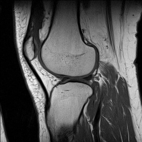 File:Bucket handle tear - medial meniscus (Radiopaedia 79028-91942 Sagittal T1 7).jpg
