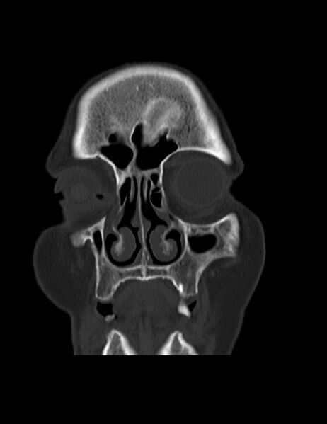 File:Burnt-out meningioma (Radiopaedia 51557-57337 Coronal bone window 4).jpg