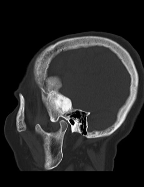 File:Burnt-out meningioma (Radiopaedia 51557-57337 Sagittal bone window 7).jpg
