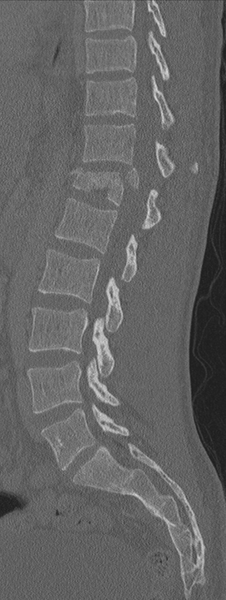 File:Burst fracture - T12 with conus compression (Radiopaedia 56825-63647 Sagittal bone window 37).png