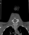 Butterfly vertebra (Radiopaedia 77903-90209 Coronal bone window 44).jpg