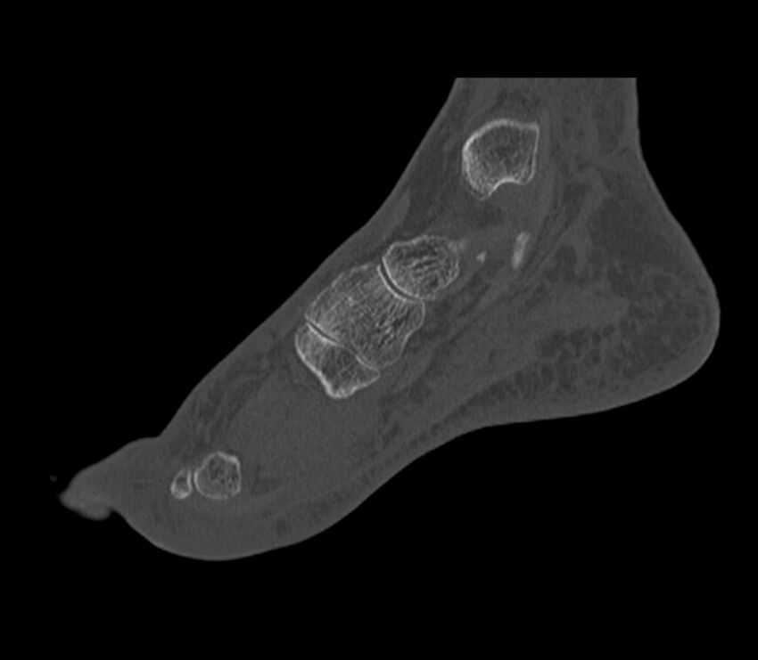 Calcaneal tuberosity avulsion fracture (Radiopaedia 22649-22668 Sagittal bone window 35).jpg