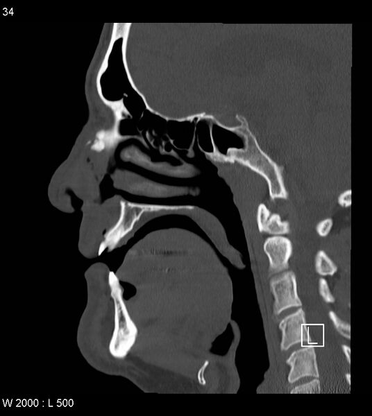 File:Calcification of the transverse band of the cruciform ligament (Radiopaedia 53063-59025 Sagittal bone window 11).jpg