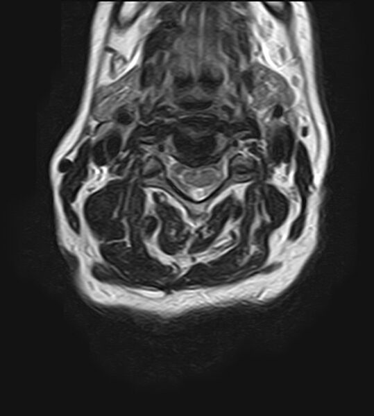 File:Calcified meningioma - cervical canal (Radiopaedia 70136-82468 Axial T2 15).jpg