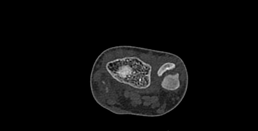 Calcifying aponeurotic fibroma (Radiopaedia 88423-105064 Axial bone window 34).jpg