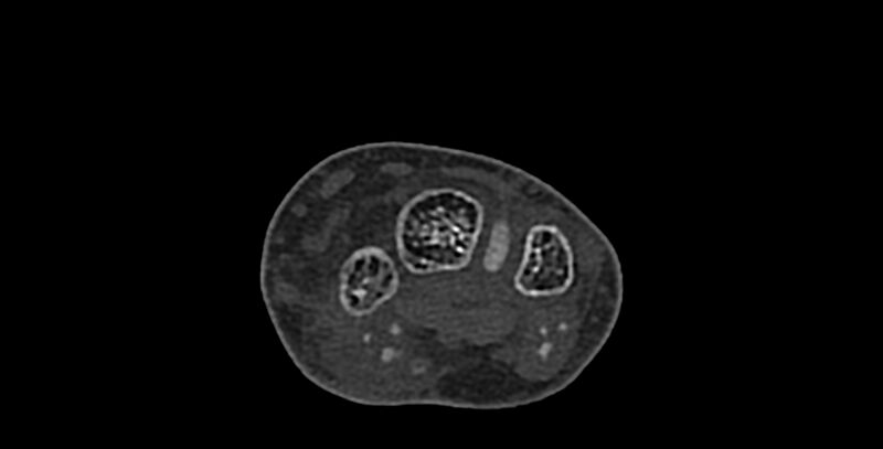 File:Calcifying aponeurotic fibroma (Radiopaedia 88423-105064 Axial bone window 73).jpg