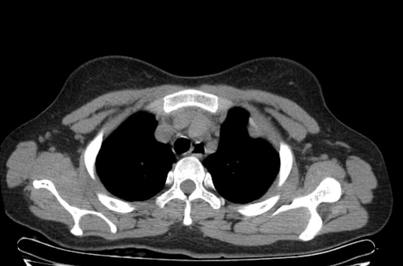 File:Cannonball metastases - uterine choriocarcinoma (Radiopaedia 70137-80173 Axial non-contrast 15).jpg