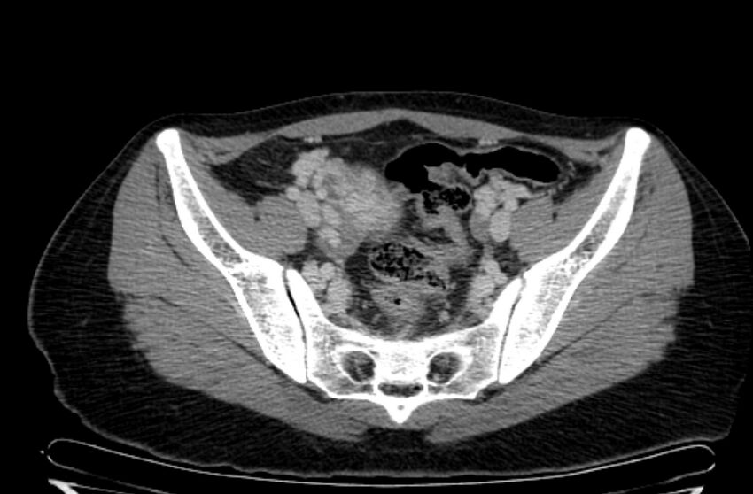 Cannonball metastases - uterine choriocarcinoma (Radiopaedia 70137-80174 A 12).jpg