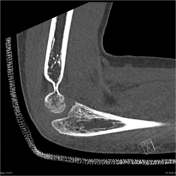 File:Capitellum fracture (Radiopaedia 23352-23426 Sagittal bone window 27).jpg