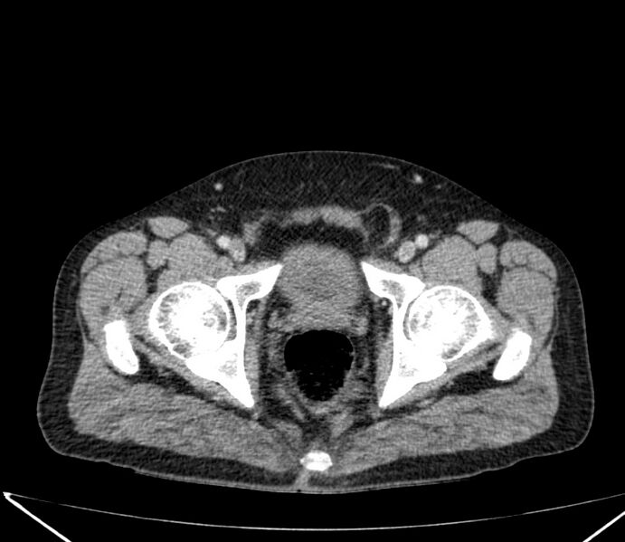 File:Carcinoid tumor with hepatic metastases (Radiopaedia 22651-22670 C 77).jpg