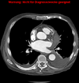 Cardiac perforation following transcatheter aortic valve implantation (Radiopaedia 23714-23863 A 2).png