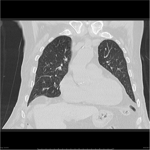 File:Cavitating left lower lobe lesion - squamous cell lung cancer (Radiopaedia 27749-28176 Coronal lung window 18).jpg