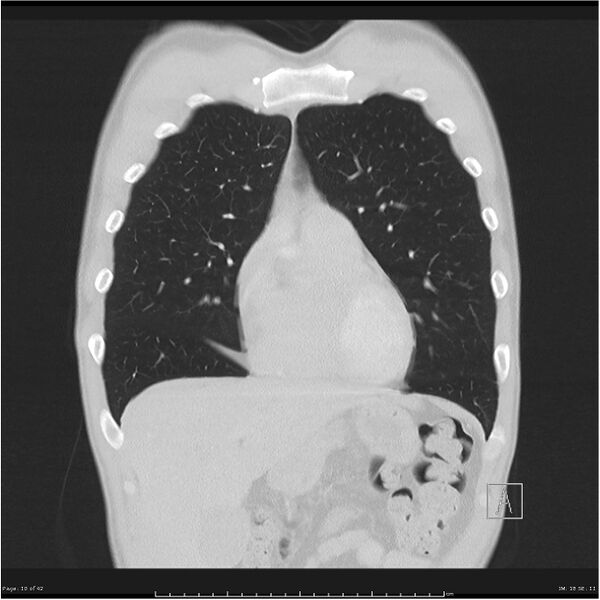 File:Cavitating lung cancer (Radiopaedia 25796-25945 lung window 10).jpg