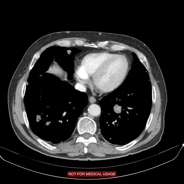 File:Cavitating pulmonary metastases (Radiopaedia 24920-25184 B 21).jpg