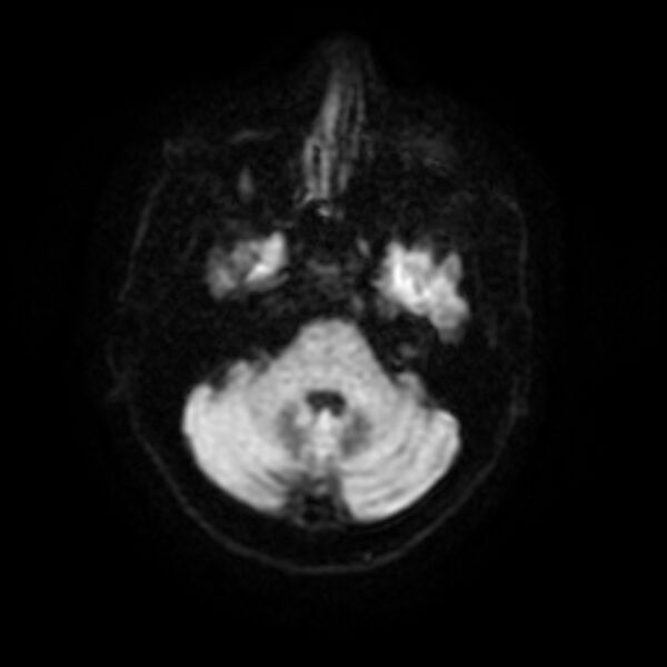 File:Central neurocytoma (Radiopaedia 67618-77021 Axial DWI 5).jpg