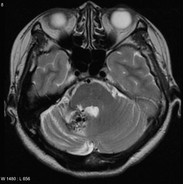 File:Cerebellar arteriovenous malformation (Radiopaedia 5220-6988 Axial T2 4).jpg