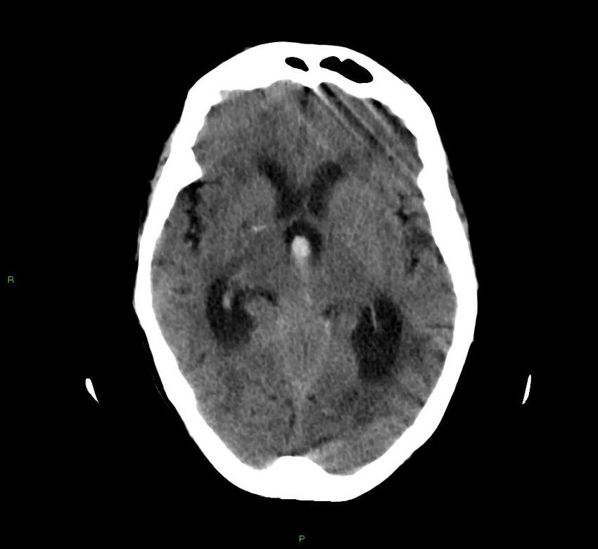 Cerebellar hemorrhage (Radiopaedia 58792-66026 Axial non-contrast 29).jpg