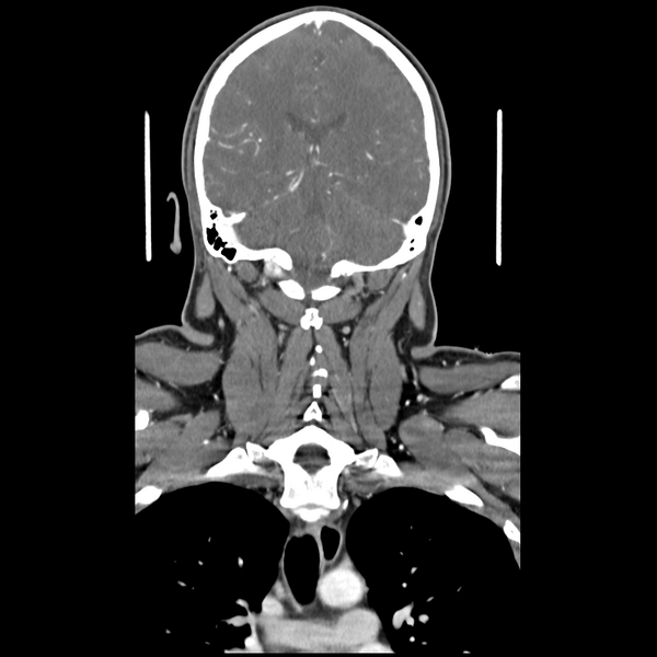 File:Cerebellar infarct due to vertebral artery dissection with posterior fossa decompression (Radiopaedia 82779-97029 D 40).png